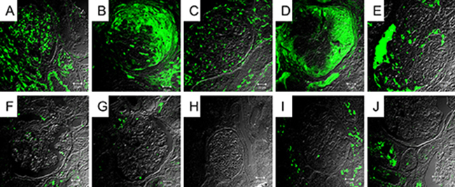 Immunofluorescence stain of C5b-9 on renal tissue from patients with lupus nephritis.