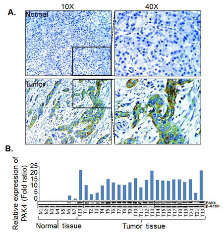 PAK4 expression analysis in pancreatic cancer tissue specimens and cell lines.