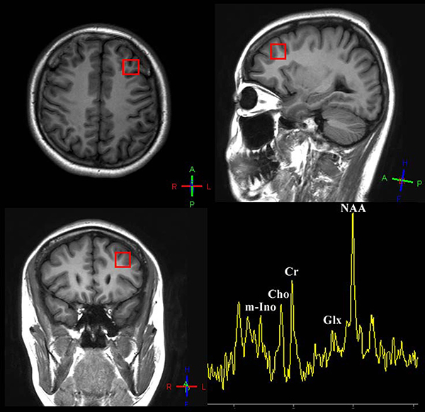 Voxel placement of interest: dorsolateral prefrontal cortex and a sample of quantifying 1H-spectrum acquired from DLPFC of patients/healthy people.