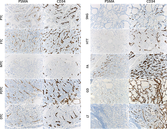 PSMA expression in malignant tumors and benign thyroid diseases.