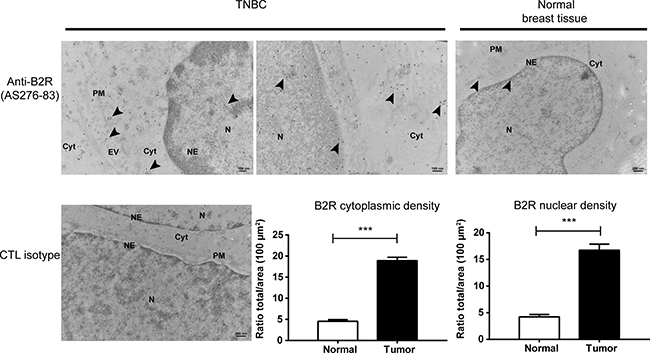 Overexpression and nuclear localization of B2R in clinical TNBC specimens.