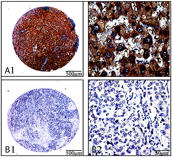 Ang-2 expression and cellular distribution by immunohistochemistryAng-2 expression in the cancerous-and their paracancerous-tissues of 122 patients with lung cancers were analyzed by immunohistochemistry with anti-human Ang-2 antibody (ab155106, Abcam, USA).