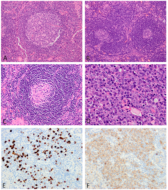 Histopathologic features of lymph nodes involved in iMCD.