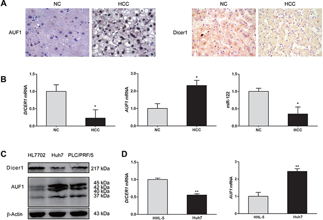 The expression of AUF1 and Dicer1 in HCC tissues and cell lines.