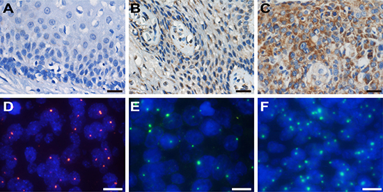 IHC staining of HMGA2 and FISH detection of HPV and HMGA2.