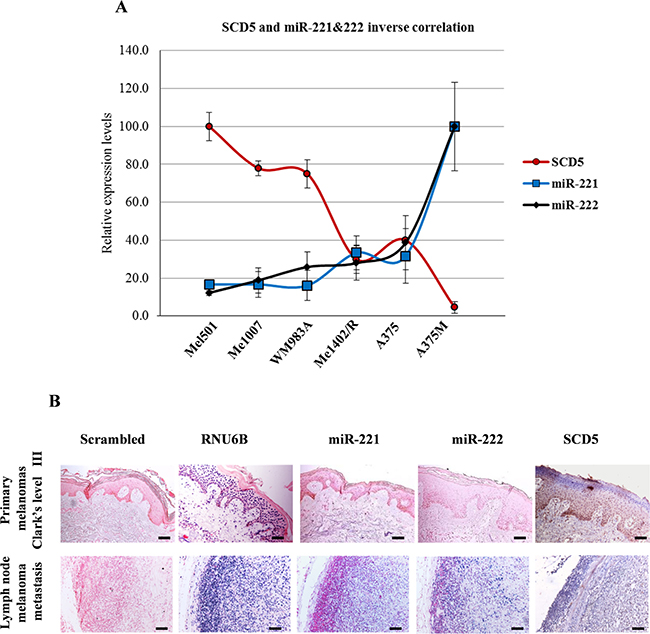 SCD5 and miR-221&#x0026;222 expressions are inversely correlated in melanoma progression.