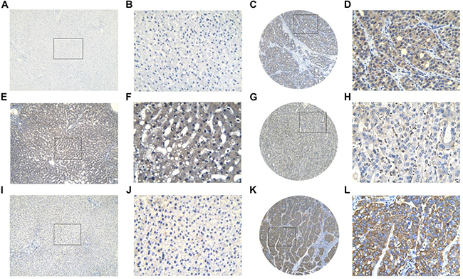 Three protein expression in HCC and non-tumor tissues assessed by immunohistochemistry.