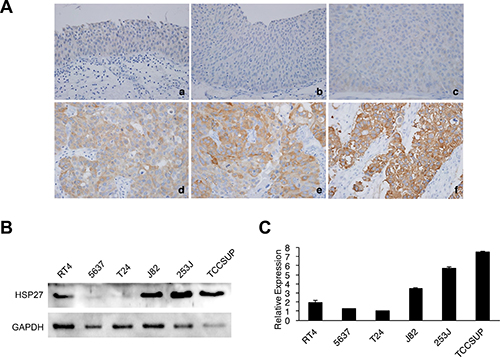 Protein expression of HSP27 in human bladder cancer (BC) tissues and cell lines.
