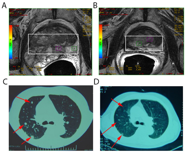 Spontaneous regression of lung metastases after cryoablation for metastatic prostate cancer.