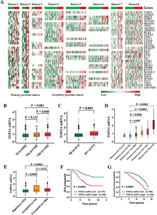 Profiling of upregulated genes in secondary prostate cancers and clinical significance of TOP2A expression in prostate cancer.