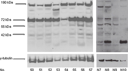 CXCR4 protein expression in vestibular schwannomas.