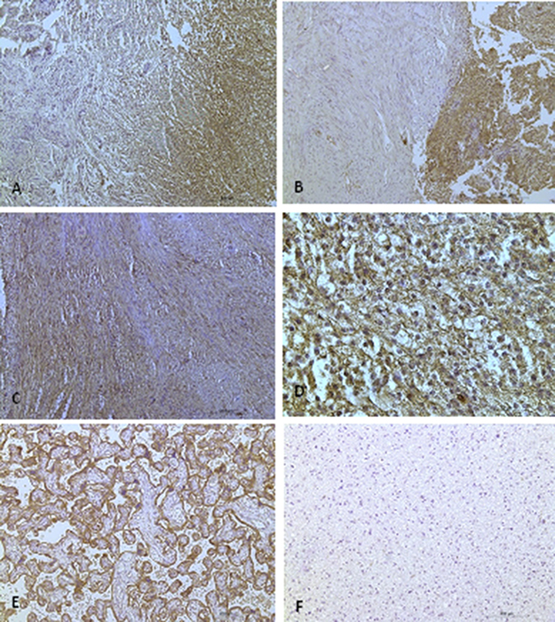 CXCR4 protein expression in vestibular schwannomas.