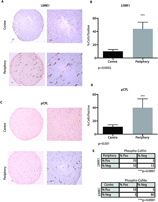 LIMK1 and pCFL are expressed in the periphery of GBM.