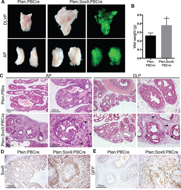 High levels of Sox9 drive Pten loss neoplasia to highly invasive prostate cancer.