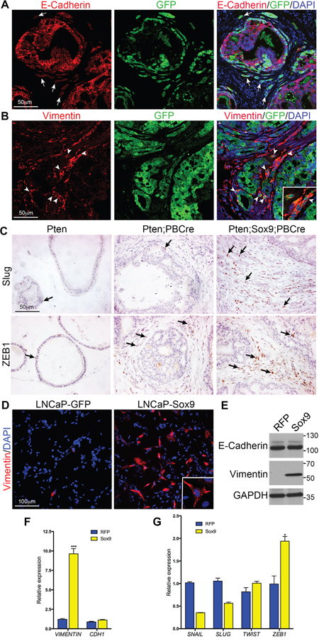 Sox9 promotes Epithelial to Mesenchymal Transition in Pten mutant prostate cells.