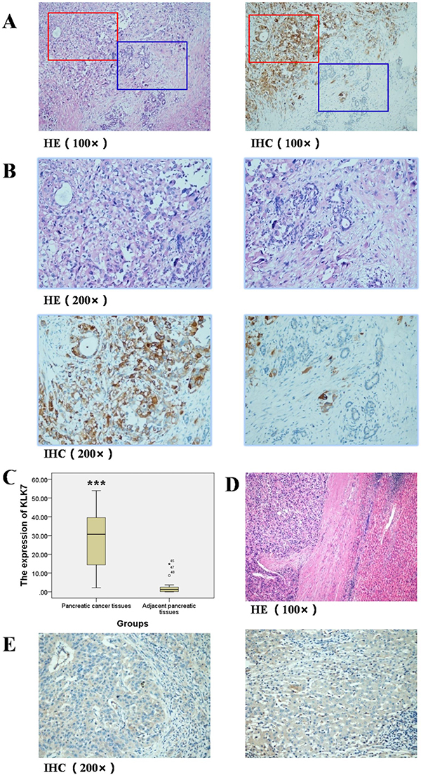 Expression of KLK7 in pancreatic cancer tissues and adjacent pancreatic tissues, hepatocellular carcinoma tissues and adjacent liver tissues.