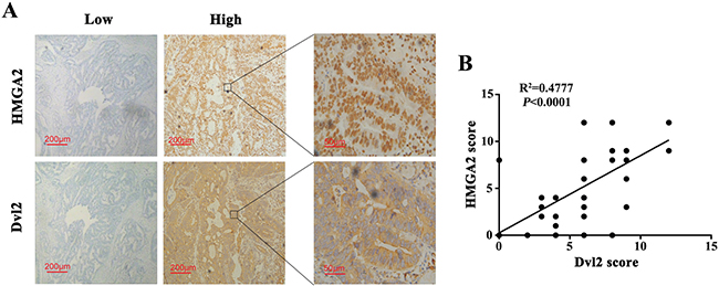 Dvl2 expression is positively correlates with HMGA2 expression in human CRC tissues.