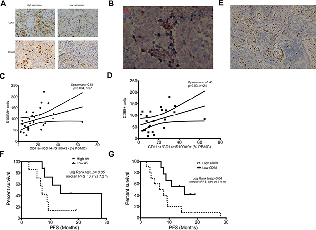 Correlation of MDSCs and TAMs between peripheral blood and tumor microenvironment.