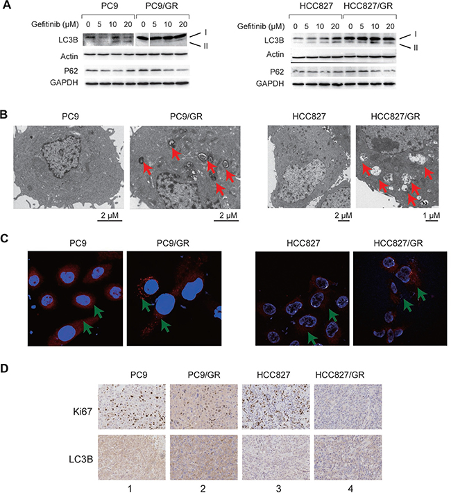 Autophagy is enhanced in the gefitinib-resistant NSCLC cells and tissues.