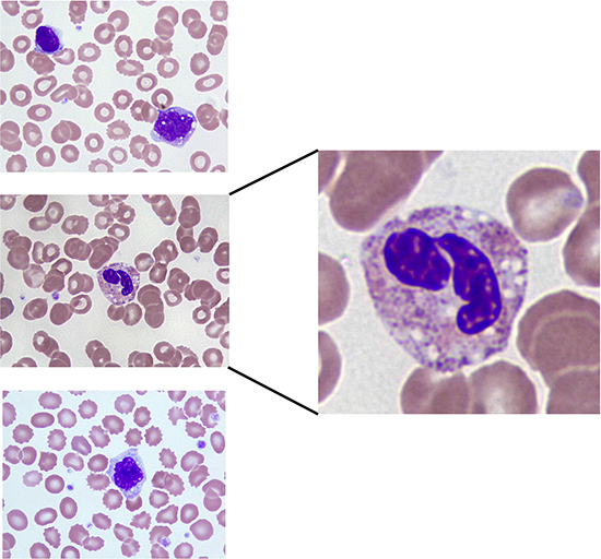 Blood smear showing vacuolated monocytes and neutrophil from a patient that experienced DLT on nelfinavir DL5.