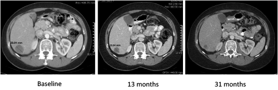 Serial CT images from a subject who achieved a sustained PR response on nelfinavir in target lesion in liver.