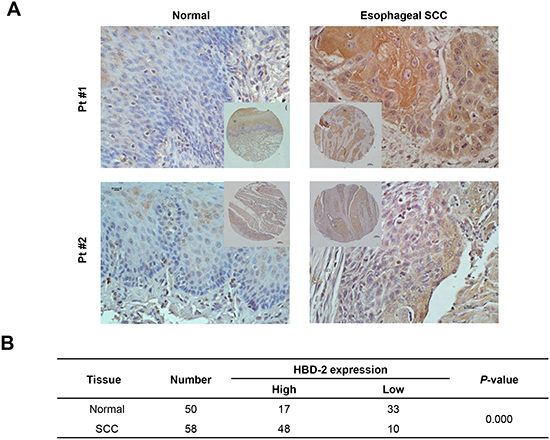 Immunohistochemistry staining of HBD-2 in human esophageal SCC.