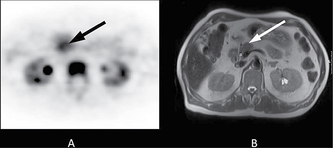70-year-old patient with a 2-cm tumour in the pancreatic head.