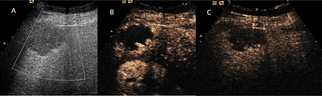 Hepatic hemangioma showed peripheral nodular enhancement in all vascular phases.