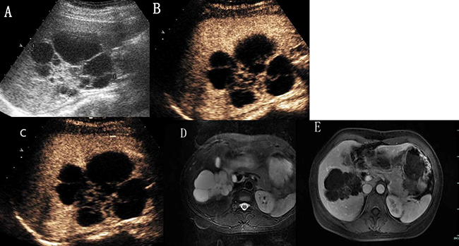 Hepatic hemangioma with septa enhancement in all vascular phases.