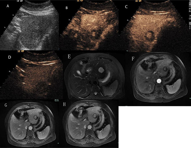 Hepatic hemangioma with centrifugal enhancement.