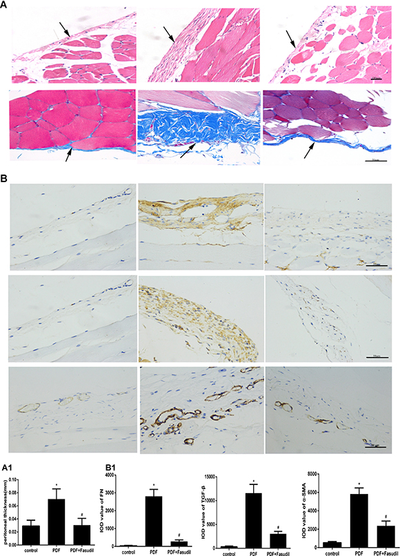 Fasudil reduces PD-associated peritoneal lesions in rats.