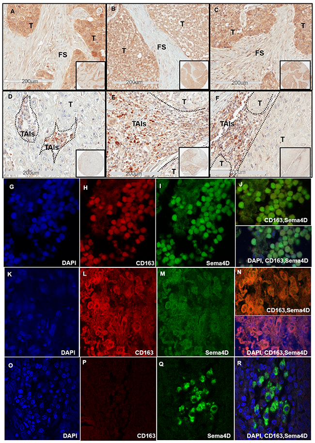 Sema4D+ve/high tumor cells correlates directly with dense peri-tumoral stroma and inversely with stromal Sema4D+ve/high TAIs.