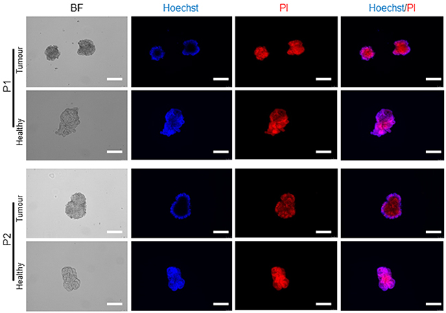 Live/dead staining in expanded tumour and healthy organoids.