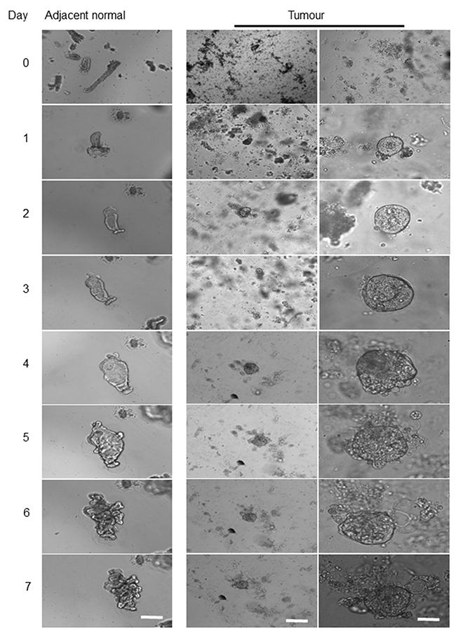 Comparison of morphological alterations in human colon matched a tumour and healthy organoids.