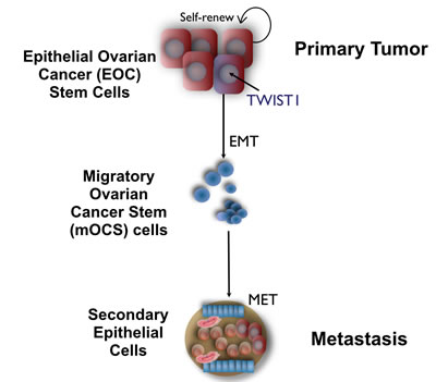 Role of TWIST1 on Epithelial Mesenchymal Transition of Epithelial Ovarian Cancer Stem cells.
