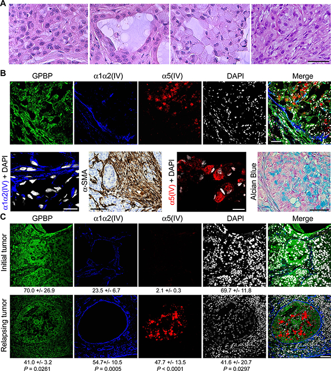 GPBP and mesh collagen IV networks associate with EMT phenotypes in human NSCLC.