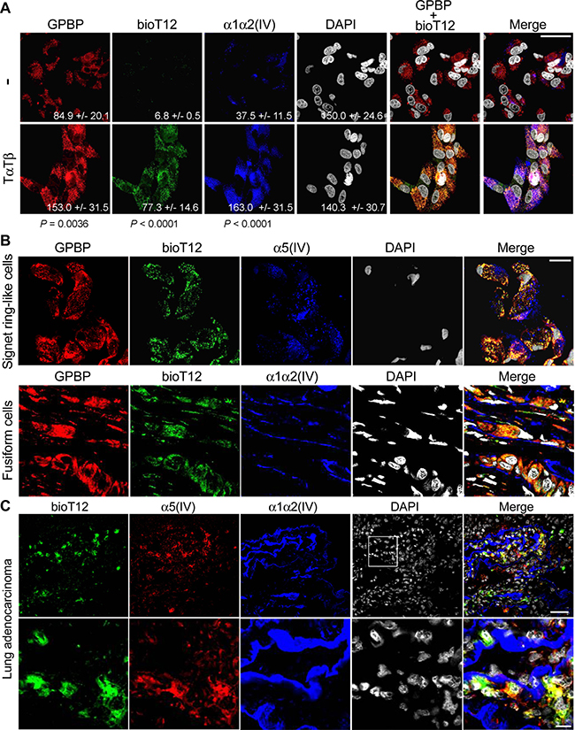 T12 selectively targets mesenchymal GPBP produced by cancer EMT phenotypes.