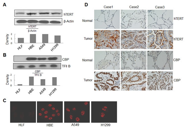 Overexpression of CBP and hTERT in lung cancer cells and tumor tissues.