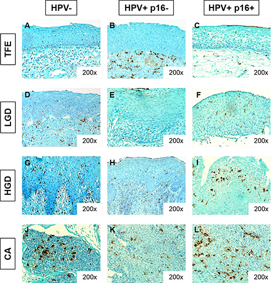 CD68+ macrophage infiltration increases during HNSCC progression, despite HPV status.