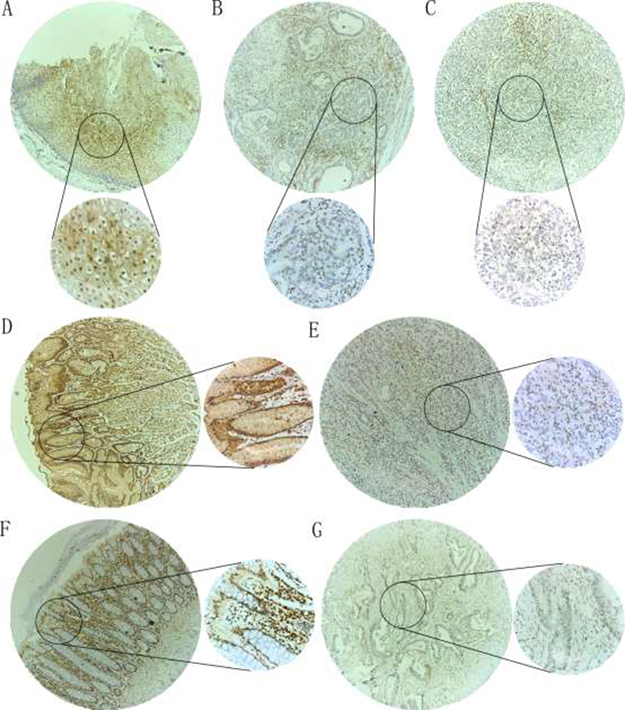 IHC staining of p27 protein in DTCs and adjacent non-tumorous tissues.