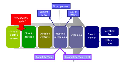 Progressive pathway to Gastric Cancer.