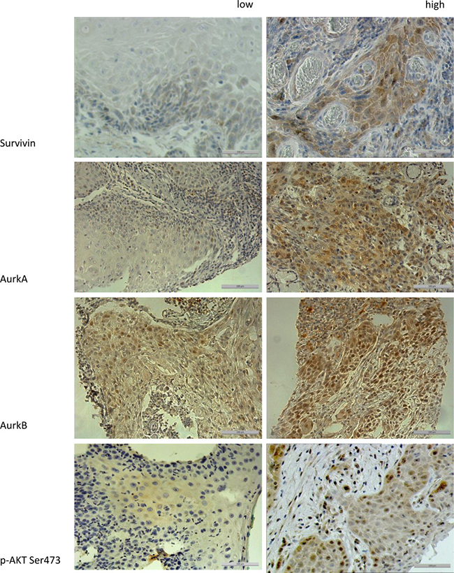 The figure shows the different expression levels (low vs. high) of the proteins Survivin, AurkA, AurkB, and p-Akt Ser 473 in immunohistochemical staining (200&#x00D7; magnification).