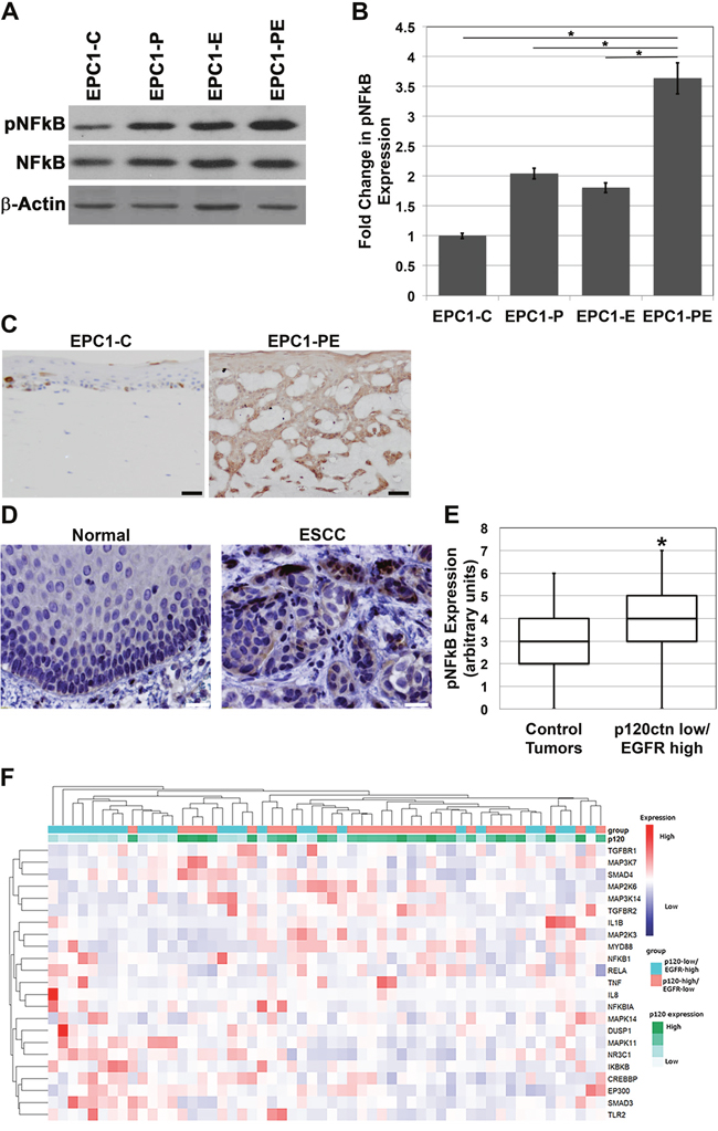 NFkB is hyperactivated in cells with p120ctn down-regulation and EGFR overexpression.