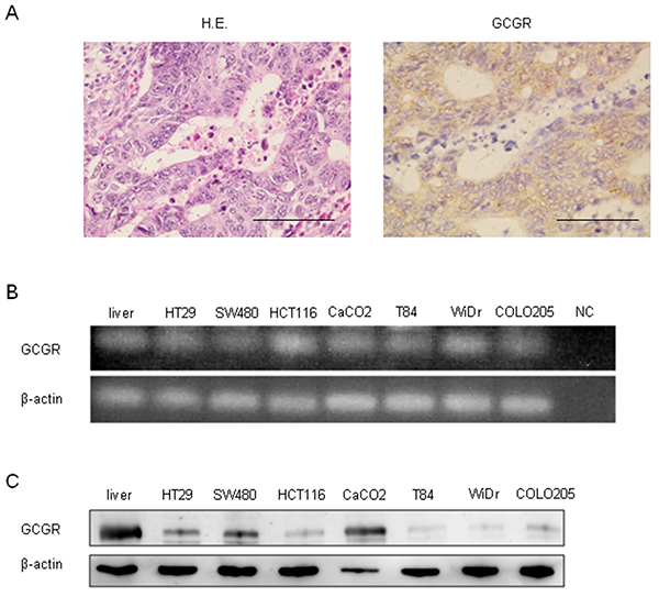 GCGR expression Expression of GCGR in human colon cancer tissue and colon cancer cell lines.