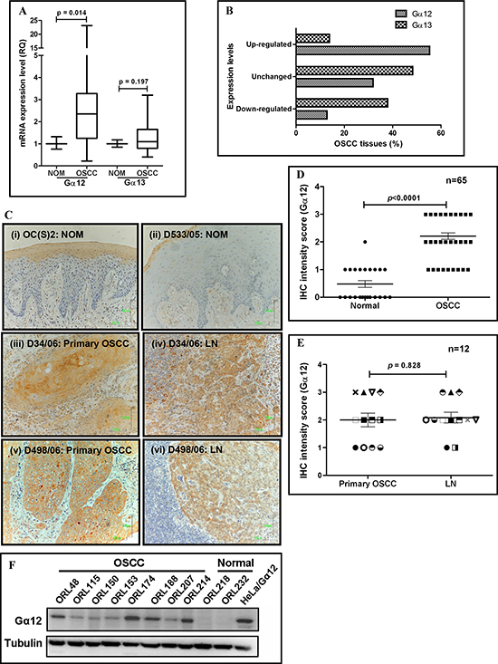 Overexpression of G&#x03B1;12 in oral squamous cell carcinoma (OSCC) tissues and cell lines.