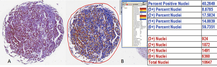Determination of Ki67 analysis by the Aperio ePathology Immunohistochemistry Nuclear Image Analysis algorithm.