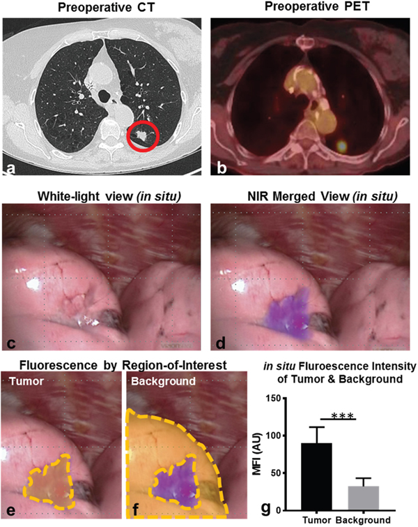 Pulmonary SCCs display in situ fluorescence during FR-IMI with OTL38.