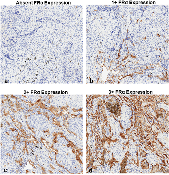 FR&alpha; expression patterns in SCCs as determined by immunostaining.