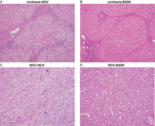 Histology of cirrhotic and hepatocellular carcinoma tissues.