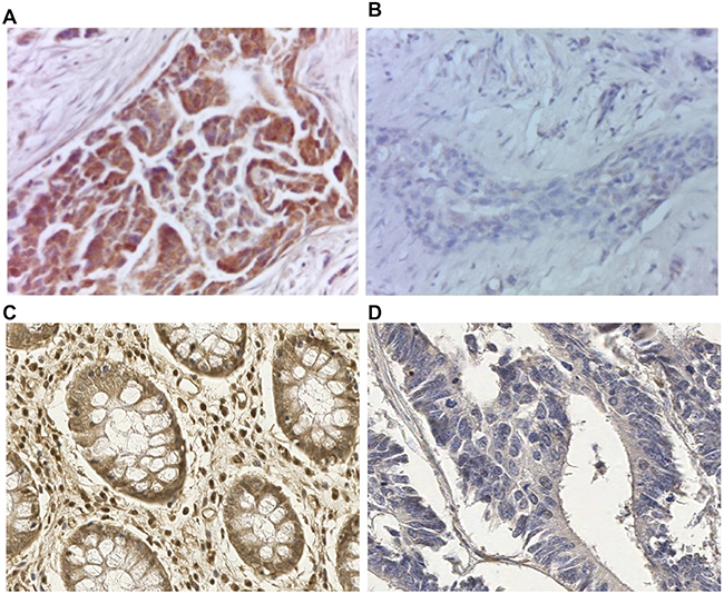 Preabsorption test to verify FUCA-1 polyclonal antibody specificity on luminal A breast cancer lesion.